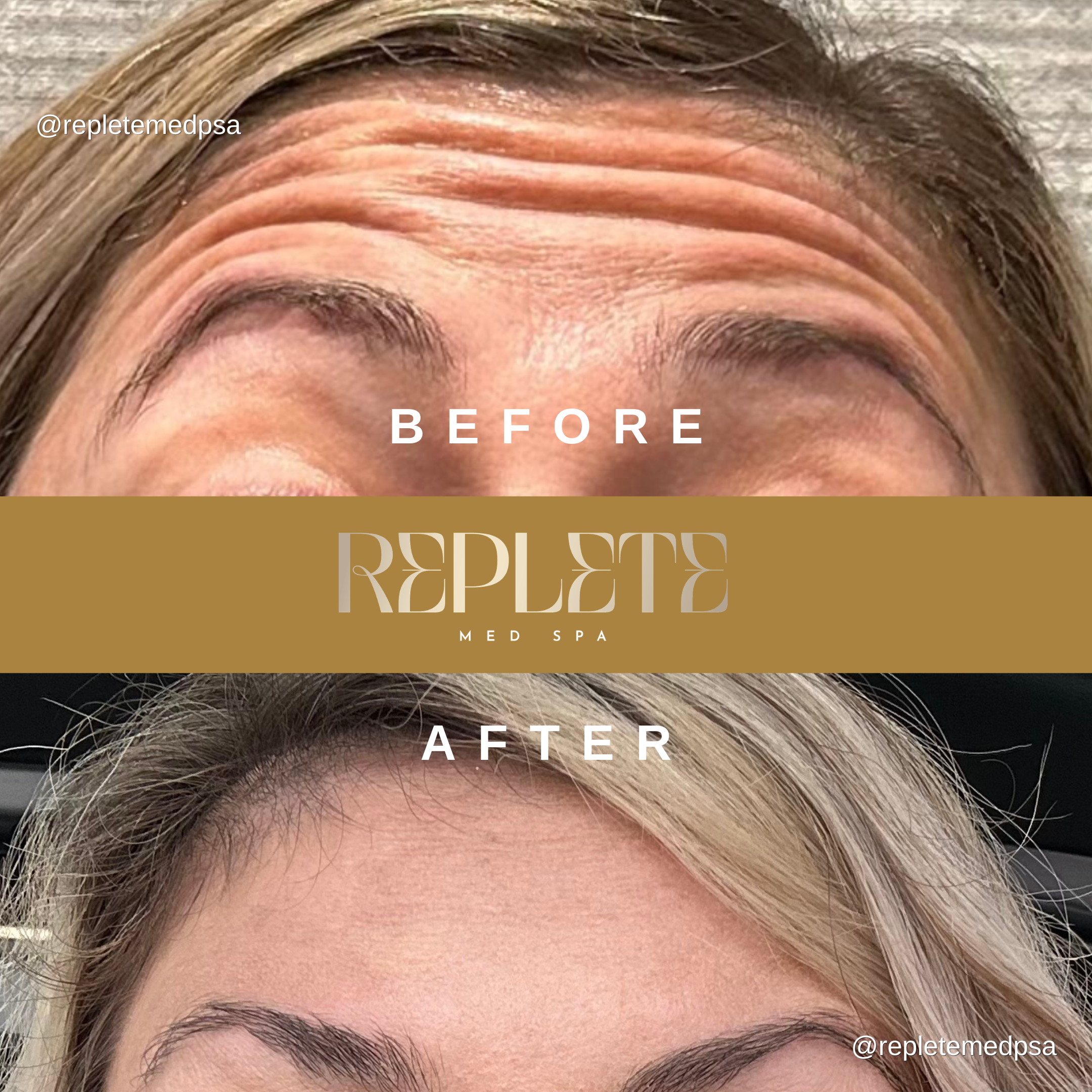 Before and After Aesthetic Treatment Results - Replete Med Spa