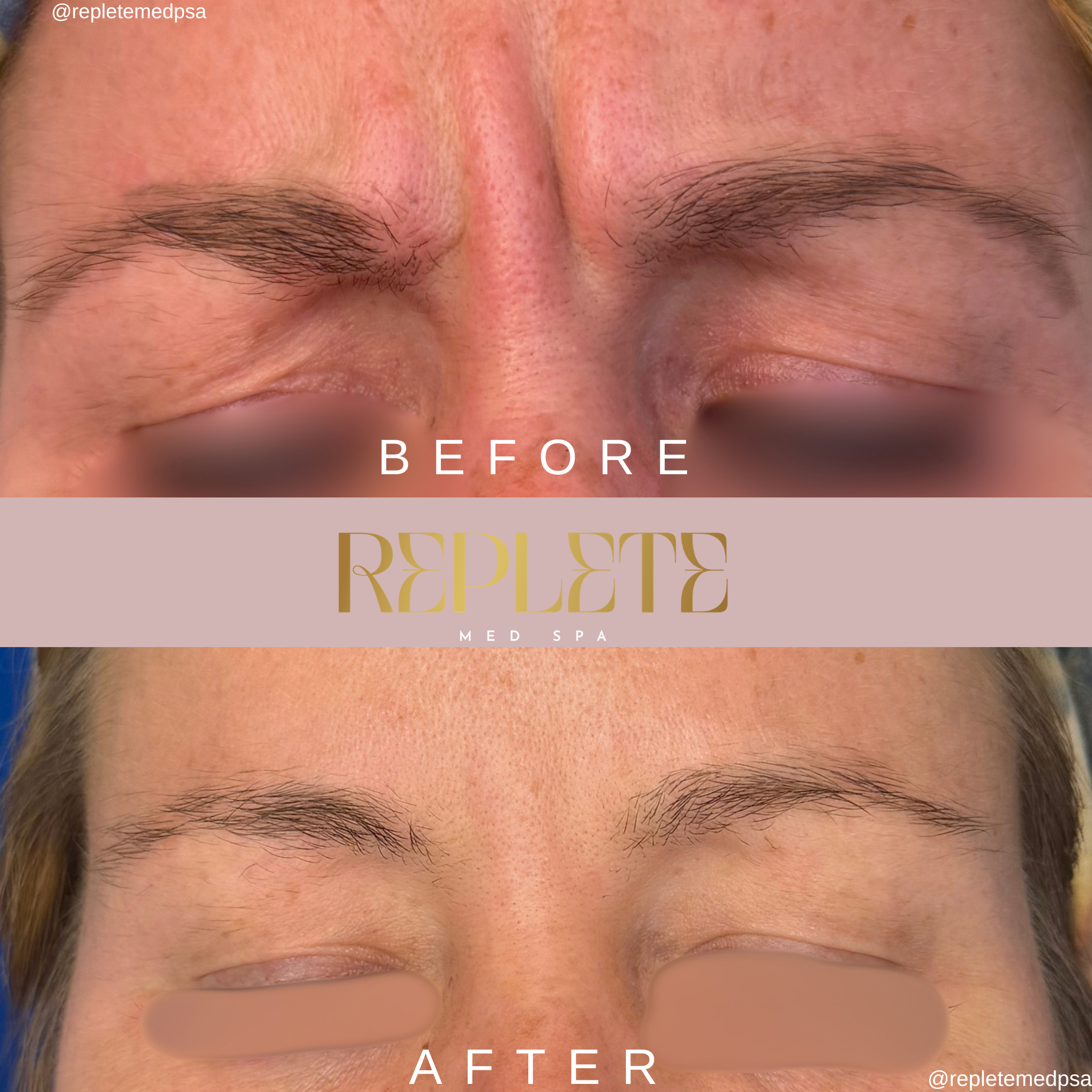 Before and After Aesthetic Treatment Results - Replete Med Spa