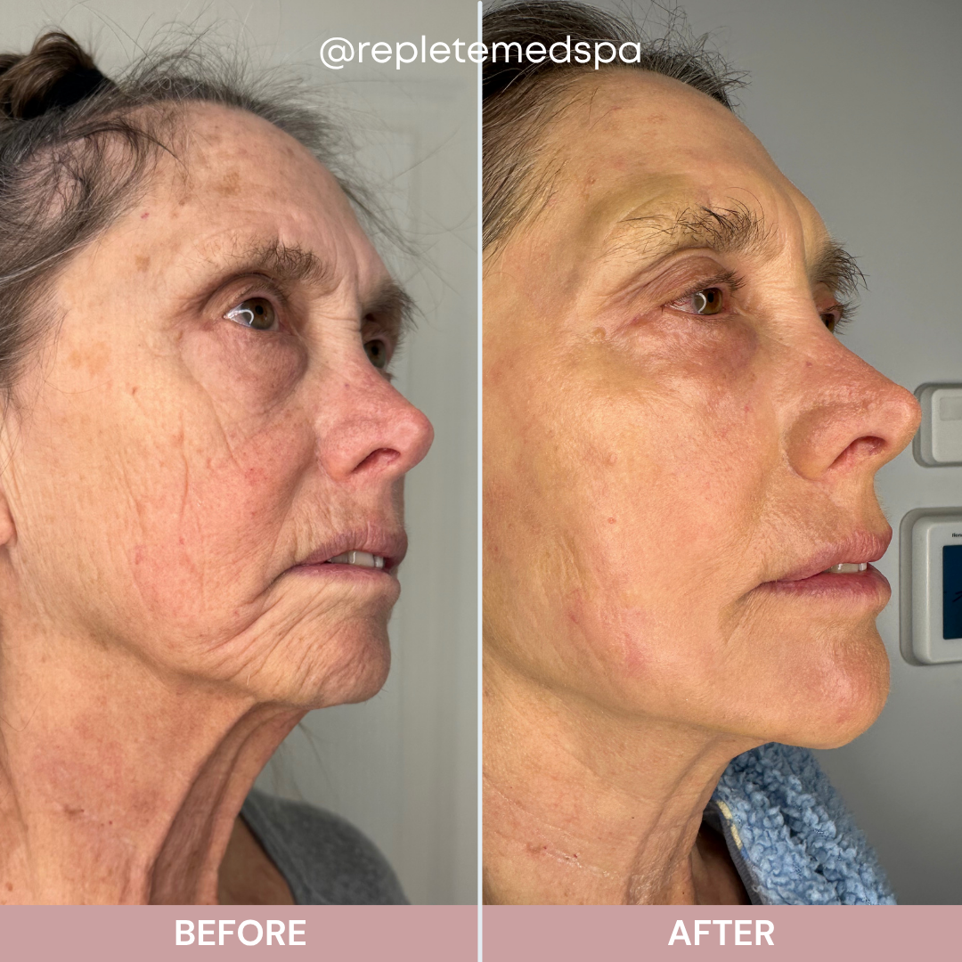 CO2 laser before and after treatment results at Replete Med Spa