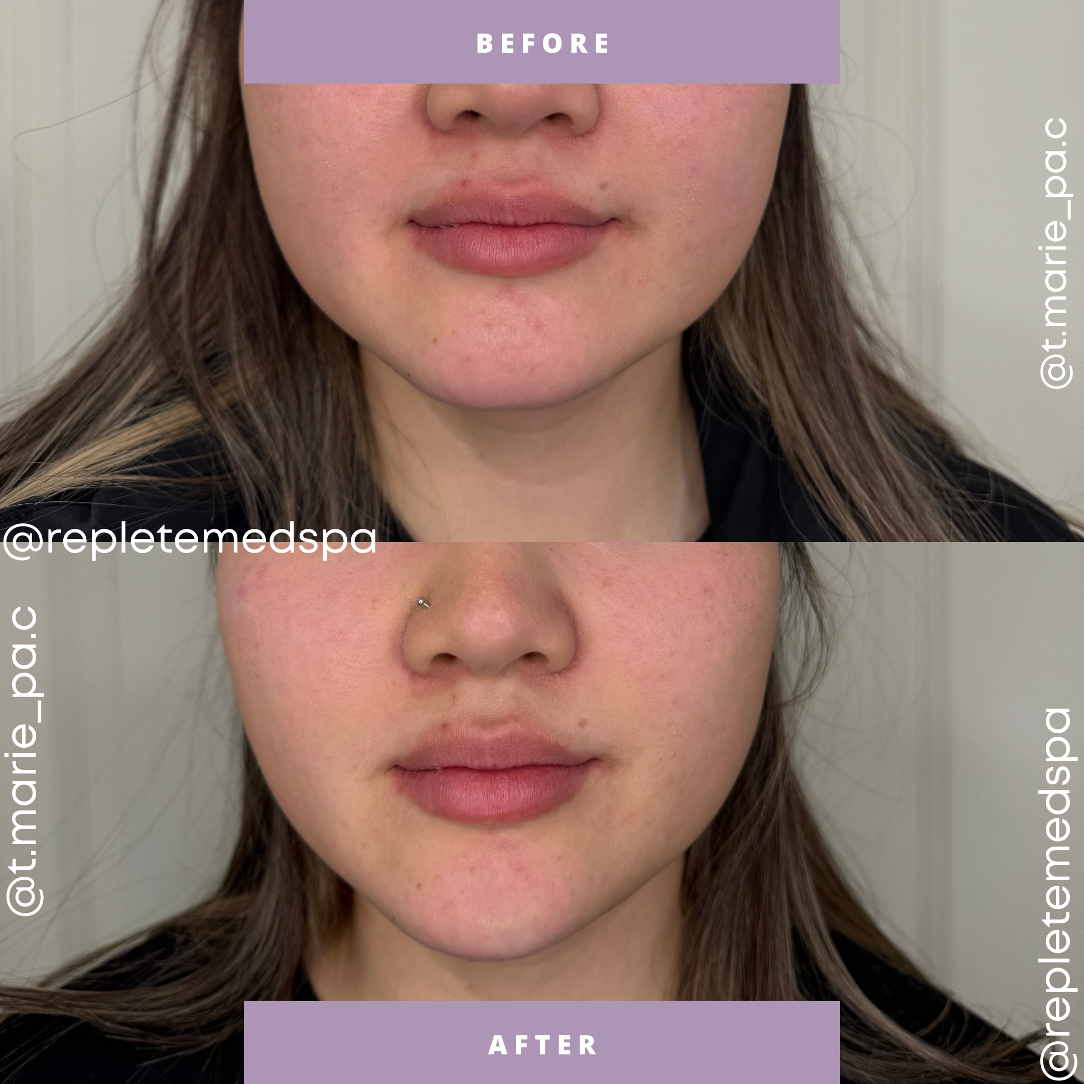 Before and after aesthetic treatment results showing the lower face and lips