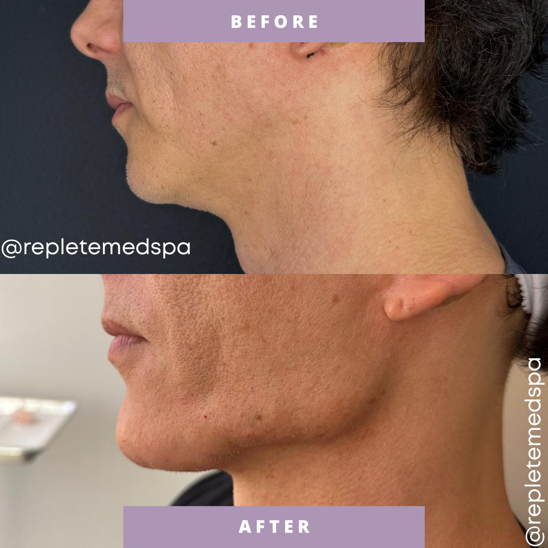Before and after jawline treatment results at Replete Med Spa